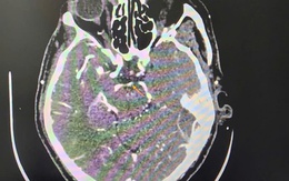 Đột quỵ khi uống bia, người đàn ông thoát chết ngoạn mục