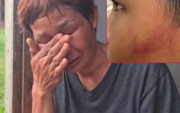 Bé trai 7 tuổi bị cô giáo dùng thước sắt đánh 14 lần vì ăn một viên kẹo