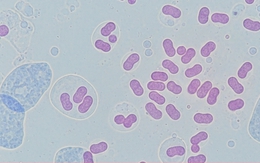 Hà Nội ghi nhận ca mắc não mô cầu là trẻ 11 tuổi, chưa tiêm vaccine