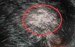 Nữ sinh 14 tuổi rụng sạch tóc vì thói quen này của nhiều người