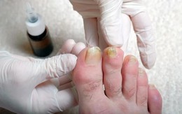 "Soi" chân bắt bệnh: 5 dấu hiệu cho thấy lá gan đang “kiệt sức”, nguy cơ UNG THƯ cận kề