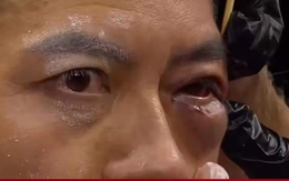 Võ sĩ Trung Quốc nguy cơ thương tật mắt vĩnh viễn khi bị hạ đo ván ở nước ngoài