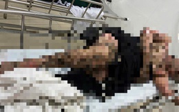 Bị bỏng toàn thân khi quăng câu vướng vào dây điện