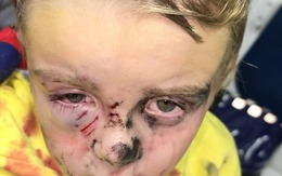 Bé trai 5 tuổi bị chó dữ tấn công khi đang đi dạo ở công viên