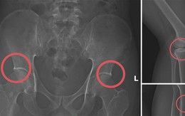 Tự đục vỡ xương để trục lợi bảo hiểm: Quá sợ kẻ vì tiền mà độc ác với chính mình