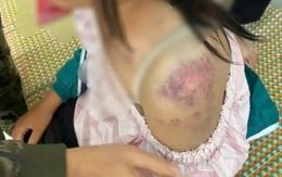 Bé gái 13 tuổi bị bà nội và hai người ông tra khảo, đánh đập dã man vì nghi trộm tiền