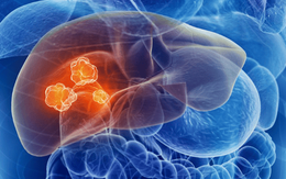 Bác sĩ cảnh báo 1 thứ âm thầm "nuôi” tế bào ung thư gan: Chưa đầy 1 năm, ung thư đã ở giai đoạn muộn