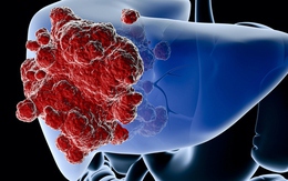 Bất ngờ phát hiện ung thư gan giai đoạn muộn từ 3 dấu hiệu lạ ở bụng