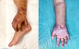 Bàn tay đứt lìa của mẹ bầu được nối lại sau thời gian 'nuôi' ở chân
