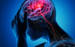 Người dễ bị đột quỵ thường có 5 đặc điểm này: Kiểm tra ngay xem bạn có không