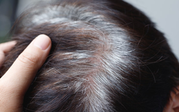 Bác sĩ nói gì về tin “tóc bạc nhiều là dấu hiệu ung thư”?