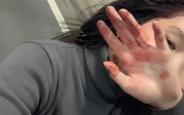 6 bất thường ở bàn tay đang ám chỉ lượng đường trong máu vượt ngưỡng an toàn, tiếc là rất ít người để ý!