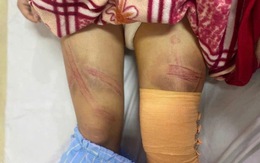 Vụ bé gái lớp 7 bị bố đánh nhập viện ở Nghệ An: Nguồn cơn từ con lợn đất?