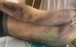 Tạm đình chỉ Trung tâm Công tác xã hội Hải Hà để điều tra vụ học viên bị đánh tử vong