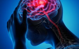 Đột quỵ gia tăng: Nghiên cứu Mỹ hé lộ thủ phạm mới