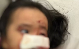 Dạo chơi cùng bố, bé gái 4 tuổi bị chó cắn nát mặt thương tâm