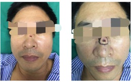 Người đàn ông Hà Nội phát hiện sự thật bàng hoàng đằng sau nốt ruồi 'phong thủy'