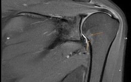 Có 1 dấu hiệu suốt 6 tháng, người phụ nữ đi khám, phát hiện khớp vai đông cứng