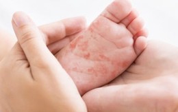 Bé gái 4 tuổi ở Hà Nội tử vong do mắc sởi