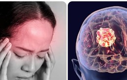 Ung thư não có những triệu chứng gì?