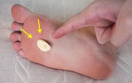 Chà tỏi lên lòng bàn chân, tưởng “vô tri” nhưng mang lại cá tá lợi ích sức khỏe, làm đẹp