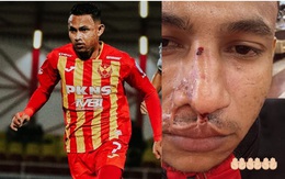 Hết bị tạt axit, đối thủ của tuyển Việt Nam lại bị gãy mũi vì sự cố bất ngờ