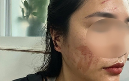 Kết quả giám định vụ cô gái cầu cứu sau khi bị bạn cùng phòng trọ hành hung rách tai vì lấy nhầm nồi nấu ăn