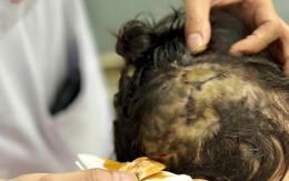 Bị chó nhà hơn 20 kg cắn vào vùng đầu, bé gái 5 tuổi phải khâu 10 mũi