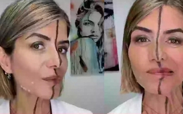 Nữ bác sĩ tiêm botox nửa khuôn mặt để chứng minh tác hại của cách làm đẹp này