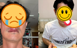 Sao nam Vbiz hoảng hốt vì bị biến dạng mặt: Hé lộ tình trạng nghiêm trọng hiện tại
