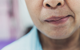 Mưa gió, nhiều người ngủ dậy bỗng méo miệng