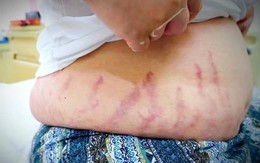 "Con tôi chỉ bị viêm mũi dị ứng thôi mà...": Người mẹ khóc nấc vì không ngờ thói quen xịt mũi lại khiến con bị suy tuyến thượng thận