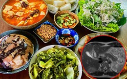 Người phụ nữ Hà Nội bất ngờ phát hiện tổn thương gan: Bác sĩ chỉ đích danh 2 thủ phạm