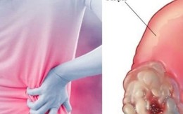 Những dấu hiệu âm thầm của ung thư thận dễ bị bỏ qua