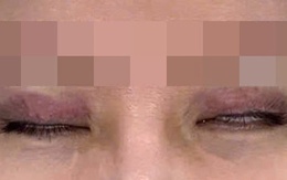 Nữ sinh 22 tuổi mắt không nhắm kín, chảy nước mắt liên tục vì thói quen làm đẹp "bất chấp" của nhiều người