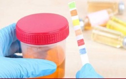 Dấu hiệu của ung thư thận dễ bị bỏ qua