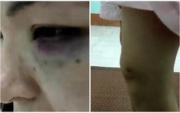 Nghi con gái bị chồng cùng mẹ chồng đánh phải chạy trốn, mẹ đẻ có hành động dứt khoát