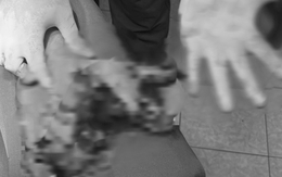 Dập nát bàn tay do nổ điện thoại khi đang sạc