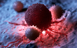 Khối u biến mất sau 4 tháng kiên trì làm 1 việc: Bác sĩ cũng phải 'vỡ òa'