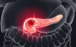Phát hiện mắc loại ung thư có tỷ lệ tử vong cao bậc nhất sau khi có 1 dấu hiệu