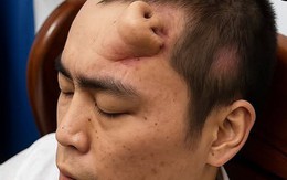 Không phải ảnh lỗi của AI, người đàn ông này đã thực sự mọc một chiếc mũi trên trán: Đó là "tác phẩm" của các bác sĩ Trung Quốc