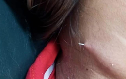 Người phụ nữ bị xương cá dài 2cm đâm xuyên qua cổ