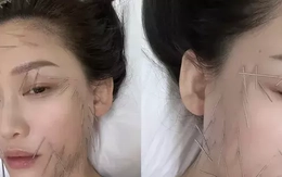 Trần Kiều Ân gây tranh cãi với phương pháp làm đẹp đau đớn