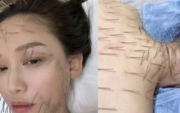 Sốc nặng hình ảnh Trần Kiều Ân cắm hàng trăm chiếc kim khắp cơ thể, làm đẹp mà chấp nhận đau đớn không tưởng!