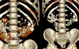 Người đàn ông suy thận nặng ở tuổi 36: Phim chụp CT khiến bác sĩ sửng sốt