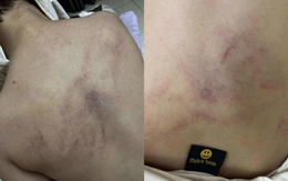 Bé gái mầm non nghi bị bạo hành, đánh tím lưng tại Hà Nội: Gia đình bàng hoàng khi biết lý do