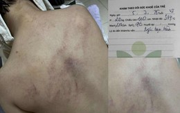 Bé gái 4 tuổi bị cô giáo ném vào tường, đánh tím lưng: Bộ Y tế vào cuộc