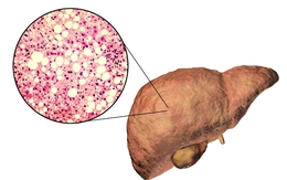 Loại thực phẩm không dầu mỡ lại có thể khiến gan "ngập" mỡ nếu ăn quá nhiều: Rất quen mặt với người Việt