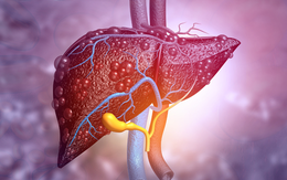 Không uống rượu bia, gan vẫn suy hỏng nặng nề nếu có thói quen này