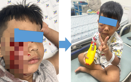 Xót xa bé trai 5 tuổi phải khâu 20 mũi ở mặt do chó cắn